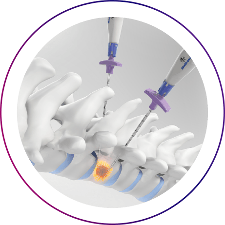 OsteoCool RF